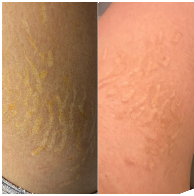 PIGMENT REMOVAL
