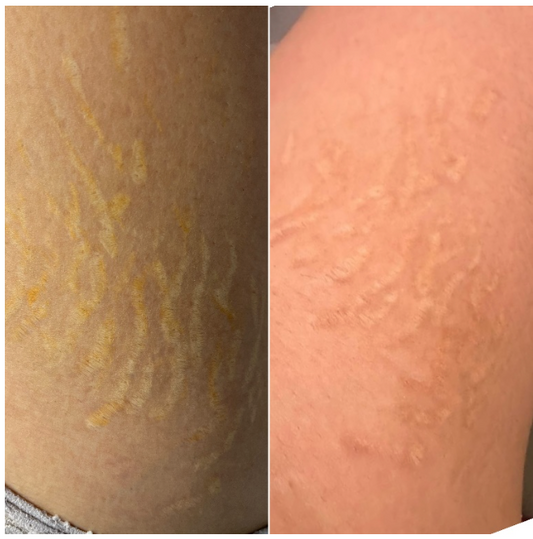 PIGMENT REMOVAL