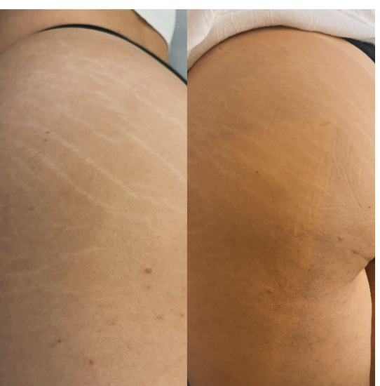 Inkless scar & stretch mark revision