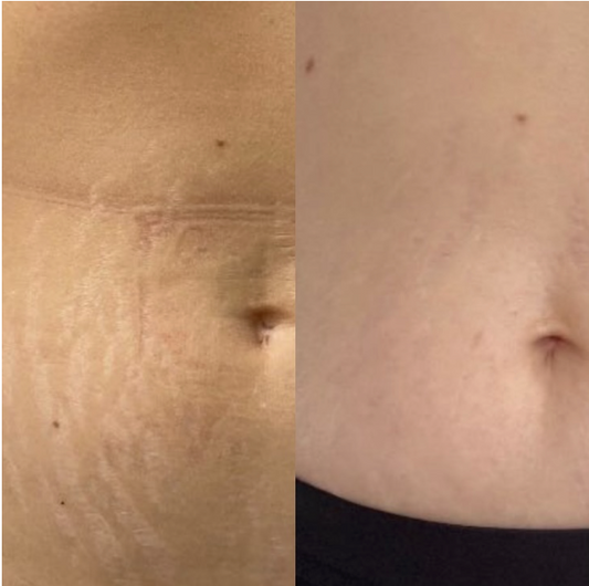 Scar & stretch mark concealer
